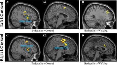 Mind-Body Exercise Modulates Locus Coeruleus and Ventral Tegmental Area Functional Connectivity in Individuals With Mild Cognitive Impairment